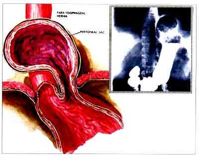 Рис. 2. Восстановление ножки предотвращает параэзофагеальную грыжу!
