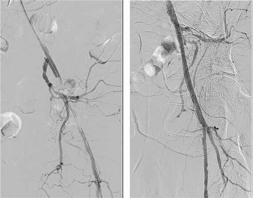 Результат ангиопластики с самораскрывающимся стентом