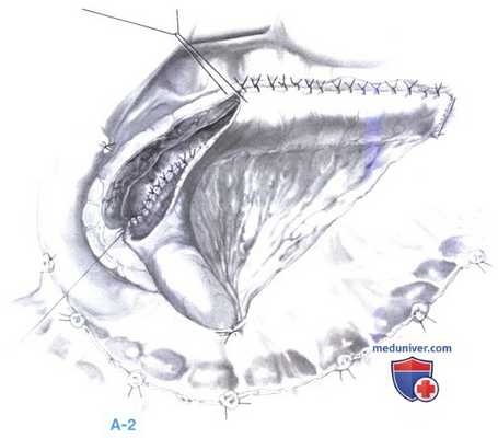 Дренирование протока в тонкую кишку при хроническом панкреатите (боковая панкреатикоеюностомия, модифицированная операция Пуэстоу (Puestow))