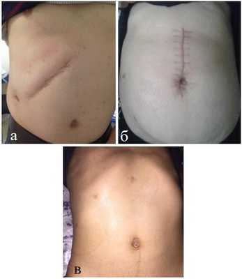 Рис. 4. Вид операционных рубцов после подреберной (а), верхне-срединной (б) лапаротомии и ЛЭЭ (в).