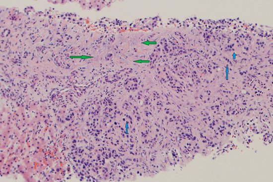 Холангиокарцинома: стадии, лечение и прогноз