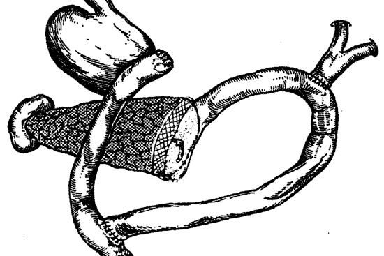 Панкреатоеюностомия