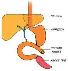 Дистальная панкреатэктомия