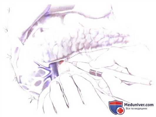 Дренирование протока в тонкую кишку при хроническом панкреатите (боковая панкреатикоеюностомия, модифицированная операция Пуэстоу (Puestow))