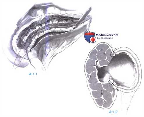 Дренирование протока в тонкую кишку при хроническом панкреатите (боковая панкреатикоеюностомия, модифицированная операция Пуэстоу (Puestow))