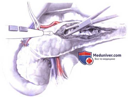 Дренирование протока в тонкую кишку при хроническом панкреатите (боковая панкреатикоеюностомия, модифицированная операция Пуэстоу (Puestow))