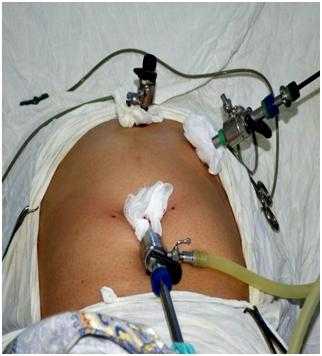 Рис. 1. Расположение троакаров при локализации ЭКП в левой доле печени.