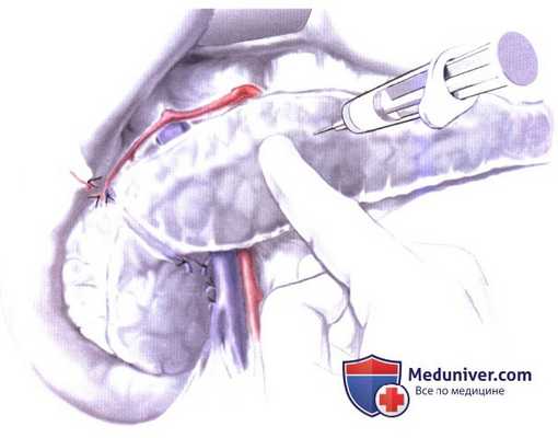 Дренирование протока в тонкую кишку при хроническом панкреатите (боковая панкреатикоеюностомия, модифицированная операция Пуэстоу (Puestow))