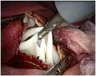 Рис. 3. Удаление хитиновой оболочки эхинококковой кисты в эндоконтейнер (эндофото собств. наблюдения).