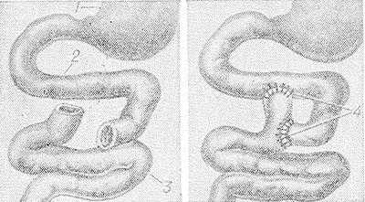 Рис. 2. Схема Y-образной дуоденоеюностомии: 1 — желудок; 2 — двенадцатиперстная кишка; 3 — тощая кишка; 4 — дуоденоеюноанастомоз.