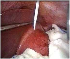 Рис. 2. Пункция эхинококковой кисты при ЛЭЭ (эндофото собственного наблюдения).