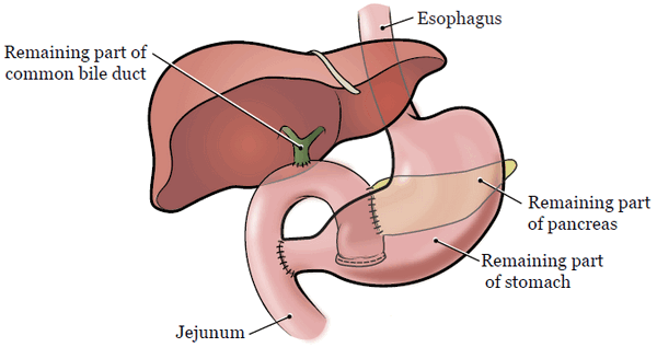 Рисунок 2. Поджелудочная железа и окружающие органы после операции
