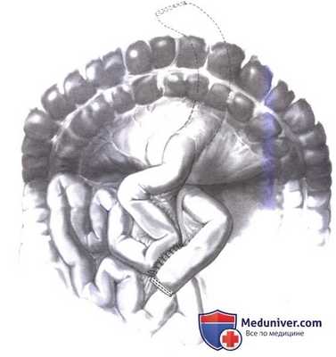 Дренирование протока в тонкую кишку при хроническом панкреатите (боковая панкреатикоеюностомия, модифицированная операция Пуэстоу (Puestow))