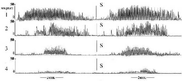 Варианты манометрических кривых