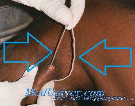 дракункулез