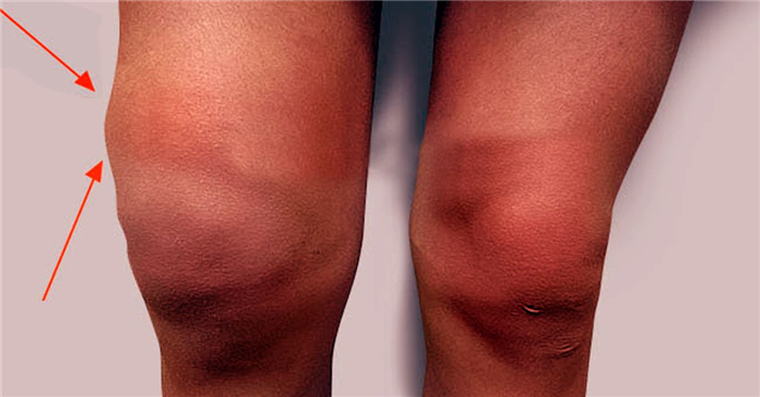 Опухание суставов