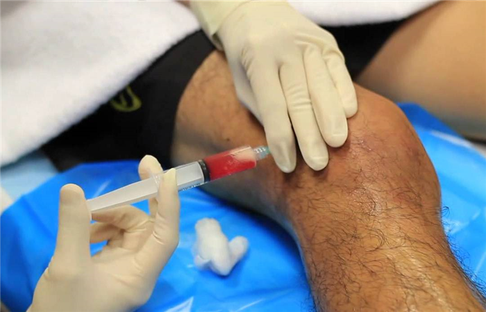 Пункция суставов