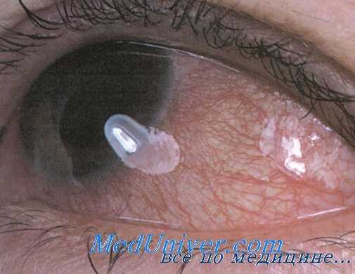 дракункулез глаз