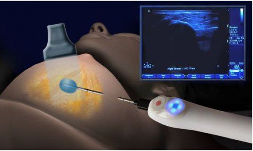 Вакуумная аспирационная биопсия