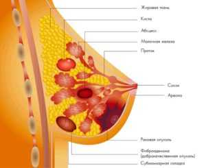 Операция абсцесса молочной железы