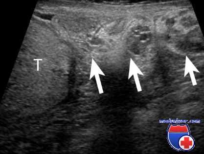 лечение гнойной инфекции
