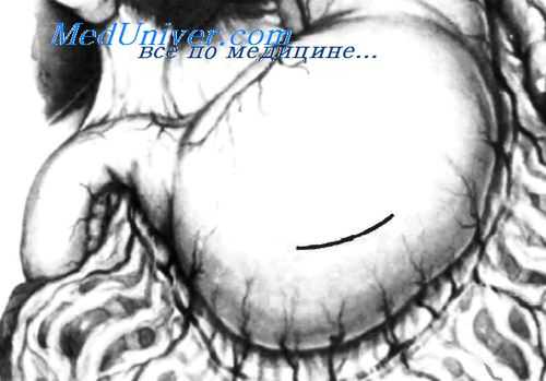 дренирование кисты