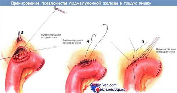 Методика дренирования псевдокисты поджелудочной железы в тощую кишку