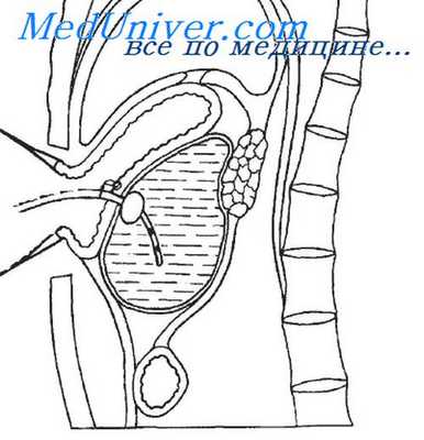 дренирование кисты