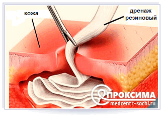  Дренирование флегмоны (абсцесса)