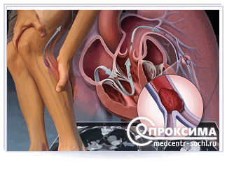 Тромбофлебит