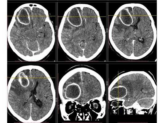 КТ головного мозга с внутривенным введением контрастного препарата