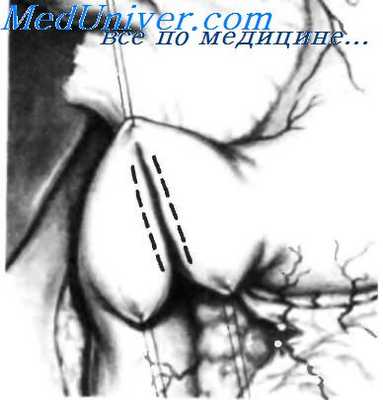 гастродуоденостомия по жабуле