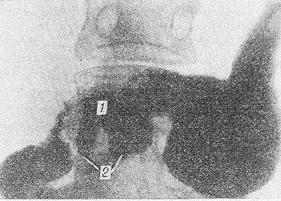 Рис. 4. Рентгенограмма желудка и двенадцатиперстной кишки после пилоропла-стики по Гейнеке—Микуличу: гастродуоденальный канал (1) с дивертикулообразными выпячиваниями (2).
