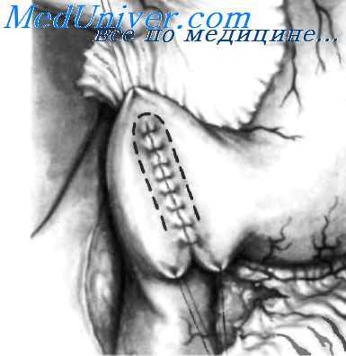 пилоропластика по финнею