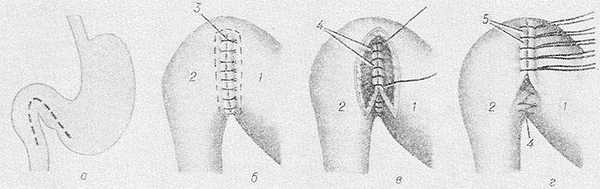 Рис. 2. Схематическое изображение пилоропластики по Финнею: а — схема желудка й двенадцатиперстной кишки (разрез показан пунктиром); б — сшивание узловыми швами (3) антрального отдела большой кривизны желудка (1) и медиальной стенки двенадцатиперстной кишки (2); в — непрерывный шов (4) через все слои на заднюю стенку анастомоза; г — узловые серозно-мышечные швы (5) на переднюю стенку анастомоза.