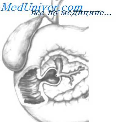 дивертикул с протоком