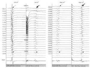 Интраоперационный мониторинг моторных ВП