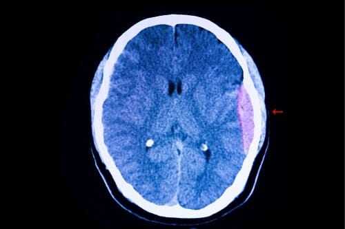 Гематома эпидуральная и подкожная