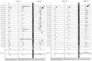 Интраоперационный мониторинг моторных ВП