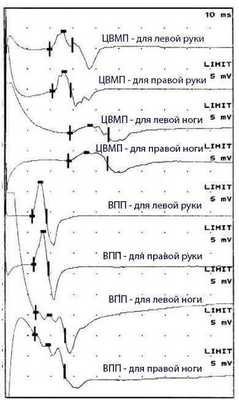 ЦВПМ и ВПП для рук и ног - схематические графики импульсов