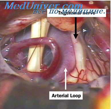 тройничный нерв