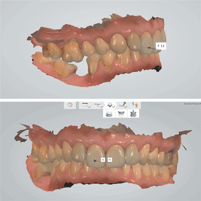 Рецессии, мезиальный наклон, глубокое перекрытие