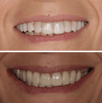 ДО и ПОСЛЕ лечения височно-нижнечелюстного сустава