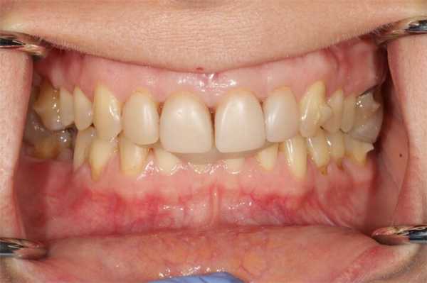 при сомкнутых зубных рядах, зубы верхней челюсти очень сильно перекрывают зубы нижней челюсти - глубокое перекрытие