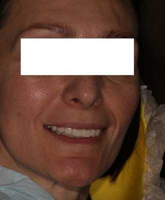 На фото вы видите примерку готовых конструкций полости рта. Оценка визуального восприятия пациентом