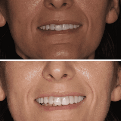 Было принято решение по изготовлению виниров и накладок на зубы