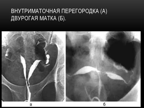 двурогая матка