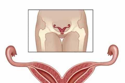 двурогая матка