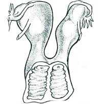Удвоение матки и влагалища