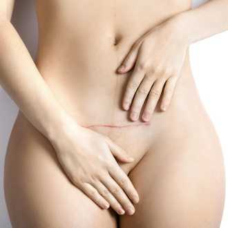 Рубец на матке